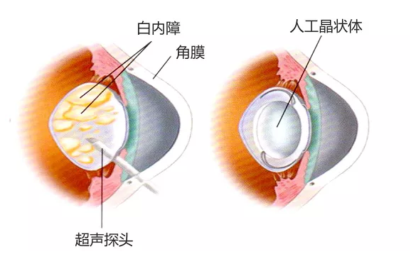 先天性白內障
